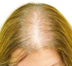 alopecia