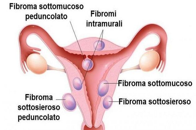 Il Fibroma uterino in Medicina Tradizionale Cinese e in micoterapia: cos’è, quali sono i sintomi ed i rimedi naturali per&nbsp;curarlo.